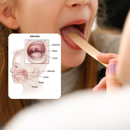 Adenoids