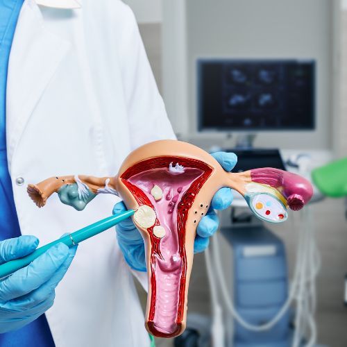 Fibroid